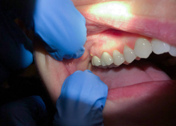 Best Urgent Care for Lost Fillings or Crowns in Syracuse, KS